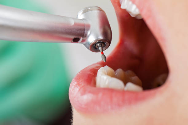 Best Emergency Wisdom Teeth Removal in High Point, FL